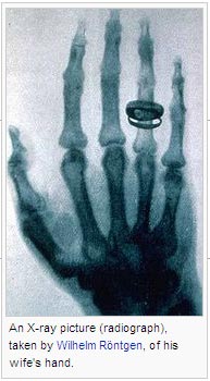 An X-ray picture (radiograph), taken by Wilhelm Röntgen, of his wife's hand