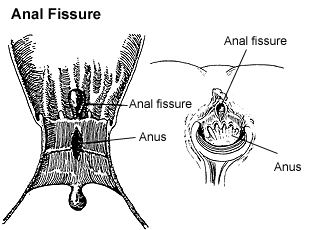 Anal Fissure picture