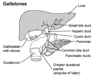 Gallstones picture