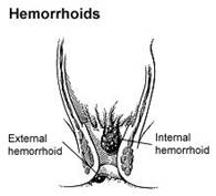 Hemorrhoids picture
