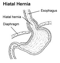 Hiatal Hernia picture