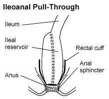 Ileoanal Pull-Through picture