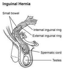 Inguinal Hernia picture
