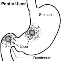 Peptic Ulcer picture